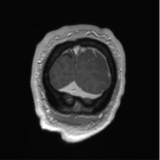 Arachnoid cyst with subdural hematoma (Radiopaedia 85892-101743 Coronal T1 C+ 6).png