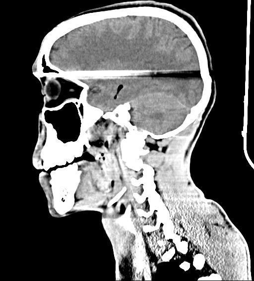 Arrow injury to the brain (Radiopaedia 72101-82607 H 26).jpg