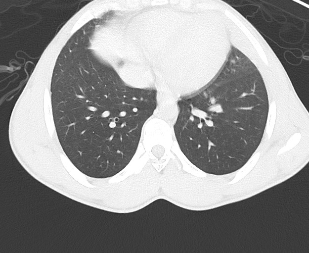 File:Arrow injury to the chest (Radiopaedia 75223-86321 Axial lung window 60).jpg