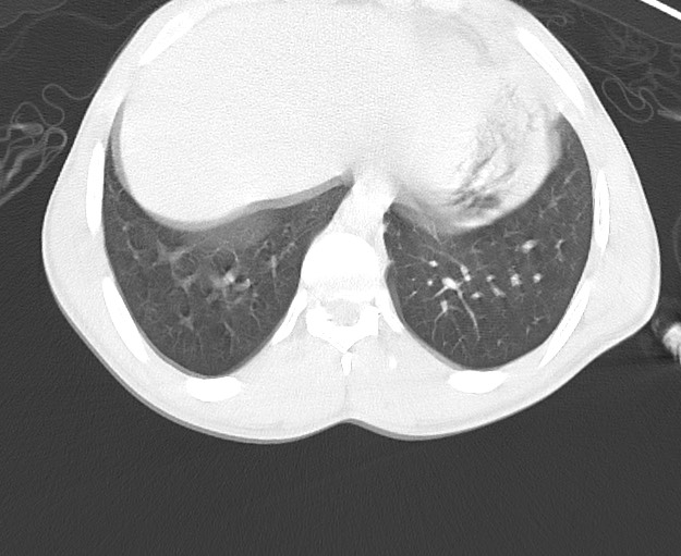 Arrow injury to the chest (Radiopaedia 75223-86321 Axial lung window 79).jpg