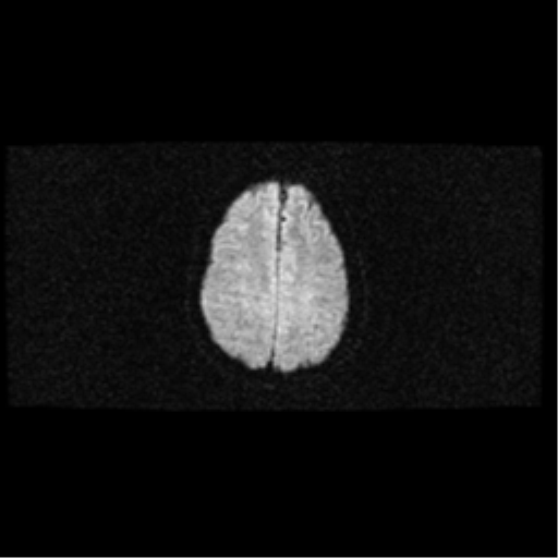 File:Arteriovenous malformation (cerebral) (Radiopaedia 40070-42580 Axial DWI 17).png