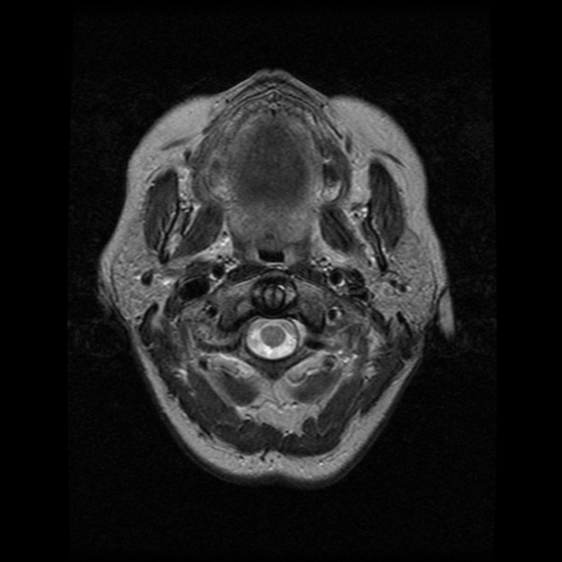 File:Arteriovenous malformation (cerebral) (Radiopaedia 40070-42580 Axial T2 1).png
