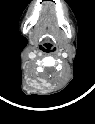 Arteriovenous malformation of the neck (Radiopaedia 53935-60062 B 22).jpg