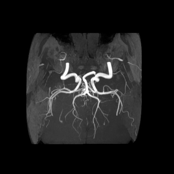 Artery of Percheron infarct (Radiopaedia 40966-43676 F 48).jpg