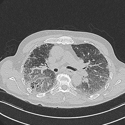 File:Aspergilloma on background pulmonary fibrosis (Radiopaedia 60942-68757 B 23).jpg