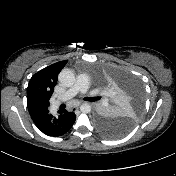 Aspiration pneumonia complicated by empyema (Radiopaedia 73024-83767 B 146).jpg