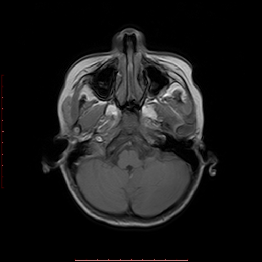 File:Astroblastoma (Radiopaedia 74287-85162 Axial T1 3).jpg