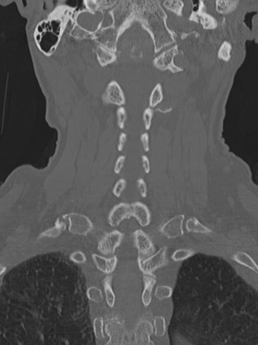 Atlanto-axial subluxation (Radiopaedia 36610-38176 Coronal bone window 31).png