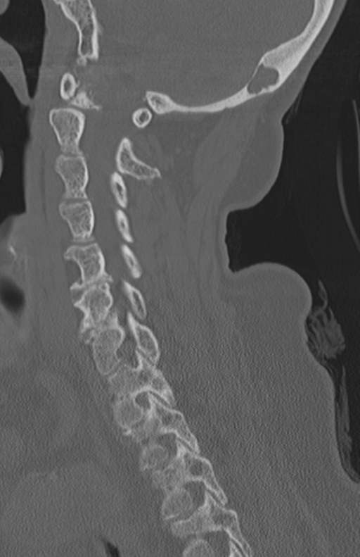 Atlanto-axial subluxation (Radiopaedia 36610-38176 Sagittal bone window 35).png