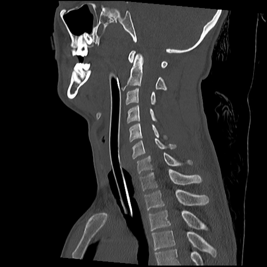 Atlanto-occipital dissociation (Traynelis type 1), C2 teardrop fracture, C6-7 facet joint dislocation (Radiopaedia 87655-104061 Sagittal bone window 35).jpg