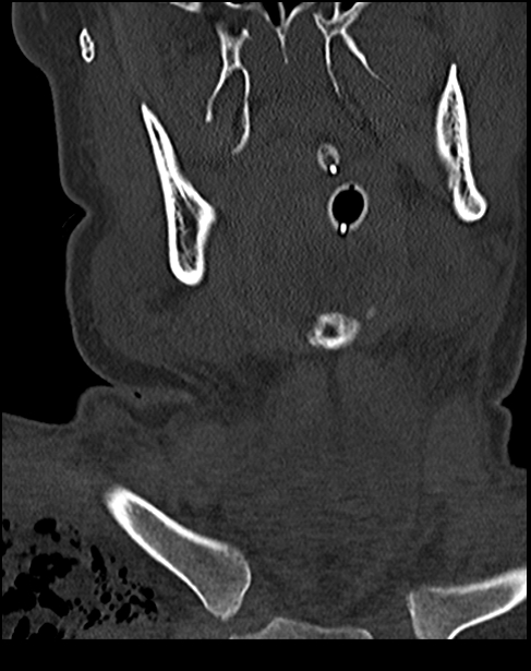Atlanto-occipital dissociation - Traynelis type 1 (Radiopaedia 87570-103948 Coronal bone window 7).jpg