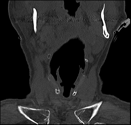 File:Atlas (type 3b subtype 1) and axis (Anderson and D'Alonzo type 3, Roy-Camille type 2) fractures (Radiopaedia 88043-104607 Coronal bone window 10).jpg
