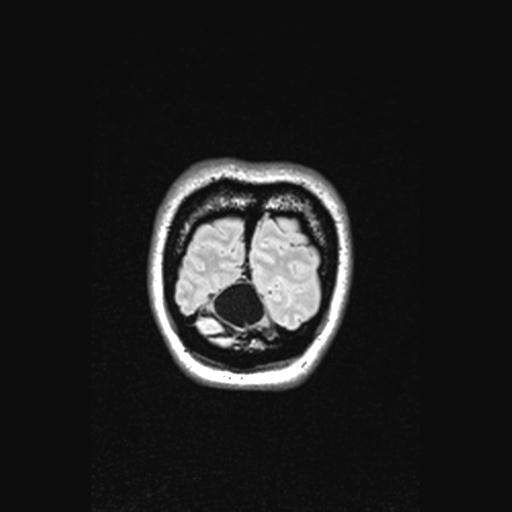 Atretic encephalocoele with inferior vermis hypoplasia (Radiopaedia 30443-31108 Coronal FLAIR 21).jpg