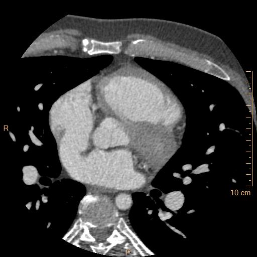 File:Atrial septal defect (upper sinus venosus type) with partial anomalous pulmonary venous return into superior vena cava (Radiopaedia 73228-83961 A 114).jpg