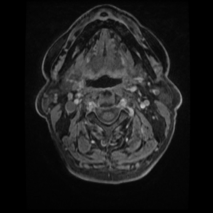 Atypical meningioma (Radiopaedia 45535-49629 Axial T1 C+ 4).jpg