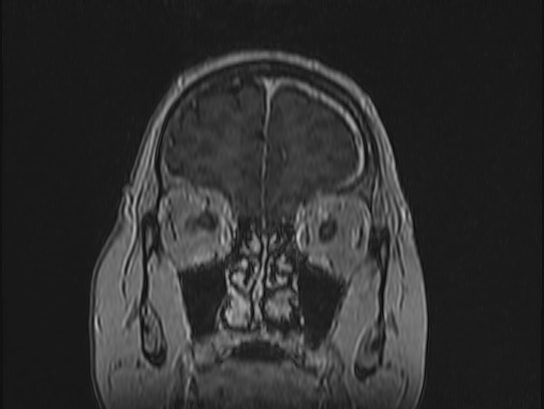 File:Atypical meningioma (Radiopaedia 62985-71406 Coronal T1 C+ 16).jpg