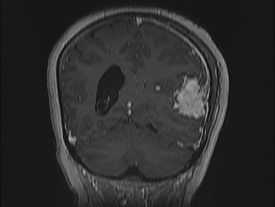 Atypical meningioma (Radiopaedia 62985-71406 Coronal T1 C+ 93).jpg