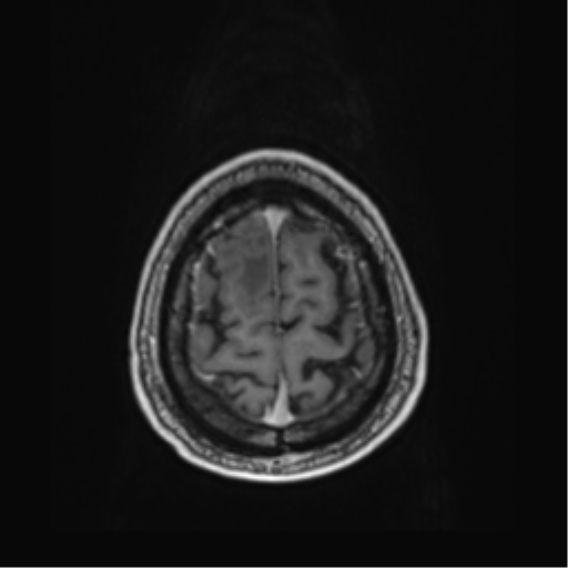 Atypical meningioma (WHO grade II) with brain invasion (Radiopaedia 57767-64729 Axial T1 C+ 45).png