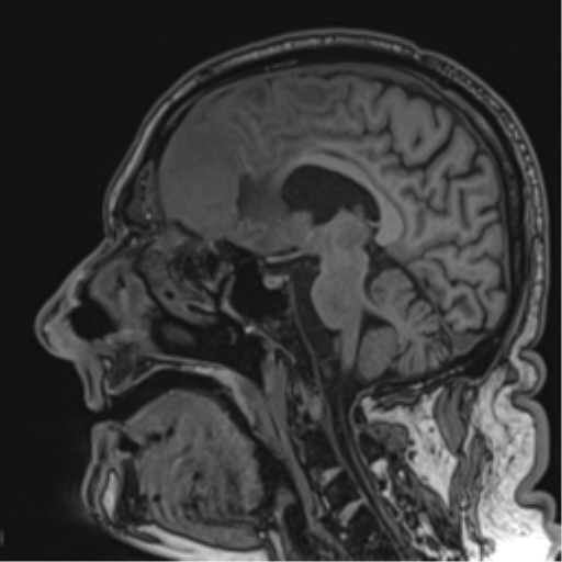 Atypical meningioma (WHO grade II) with brain invasion (Radiopaedia 57767-64729 Sagittal T1 38).png