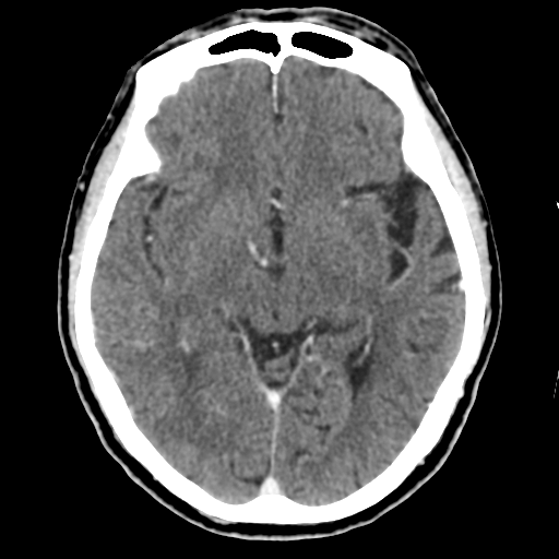 Atypical meningioma (WHO grade II) with osseous invasion (Radiopaedia 53654-59715 Axial C+ delayed 25).png