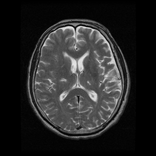 File:Atypical meningioma (WHO grade II) with osseous invasion (Radiopaedia 53654-59716 Axial T2 12).png