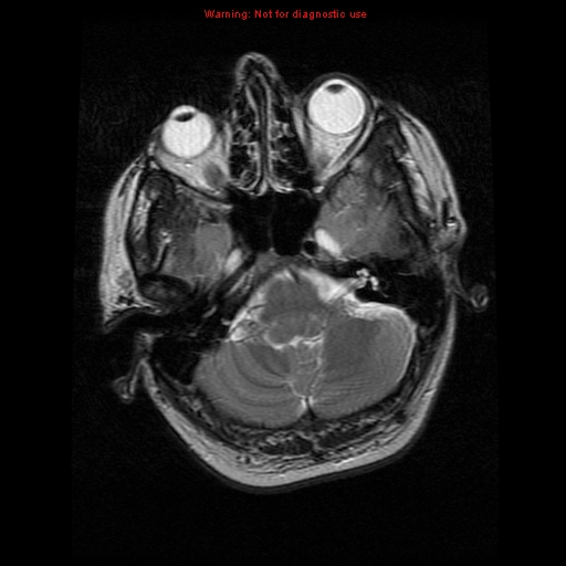 File:Atypical meningioma - grade II (Radiopaedia 13303-13305 Axial T2 5).jpg