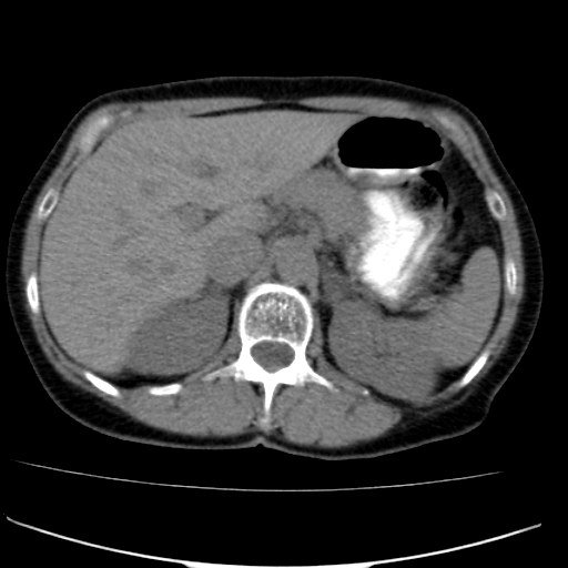 File:Atypical renal cyst (Radiopaedia 17536-17251 non-contrast 7).jpg