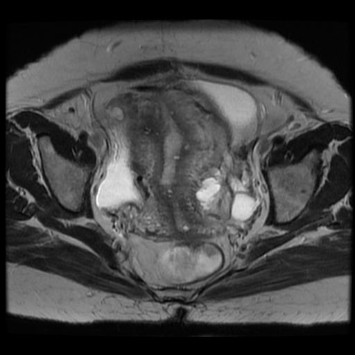 File:Atypical retroperitoneal lymphocoeles with large leiomyoma of uterus (Radiopaedia 32084-33027 Axial T2 22).jpg
