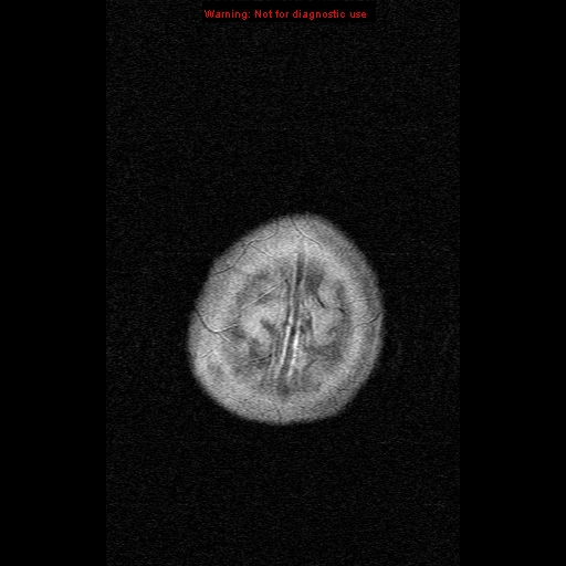 File:Atypical teratoid rhabdoid tumor (Radiopaedia 10712-11183 Axial FLAIR 1).jpg