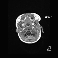 Atypical teratoid rhabdoid tumor (prenatal US and neonatal MRI) (Radiopaedia 59091-66388 Axial T1 C+ 6).jpg