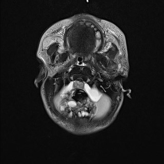 File:Atypical teratoid rhabdoid tumor (prenatal US and neonatal MRI) (Radiopaedia 59091-66388 Axial T2 6).jpg