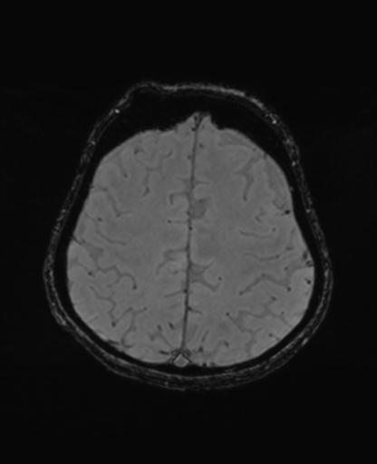 Autoimmune limbic encephalitis (Radiopaedia 30363-31005 SWI - magnitude 61).jpg