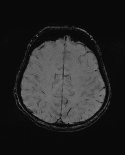 Autoimmune limbic encephalitis (Radiopaedia 30363-31005 SWI 58).jpg