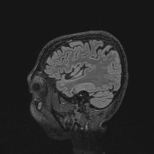 Autoimmune limbic encephalitis (Radiopaedia 30363-31005 Sagittal FLAIR 120).jpg