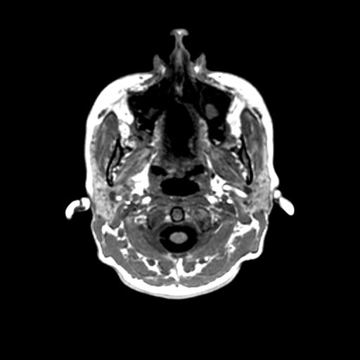 Autoimmune limbic encephalitis (Radiopaedia 30363-31005 T1 Axial 1mm 1).jpg