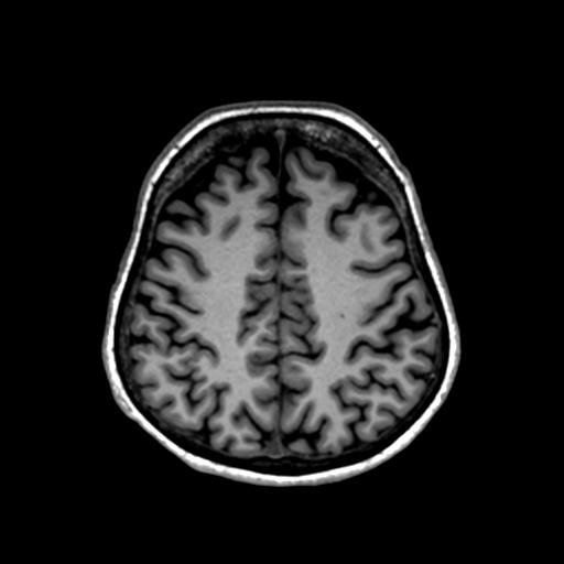 Autoimmune limbic encephalitis (Radiopaedia 30363-31005 T1 Axial 1mm 111).jpg