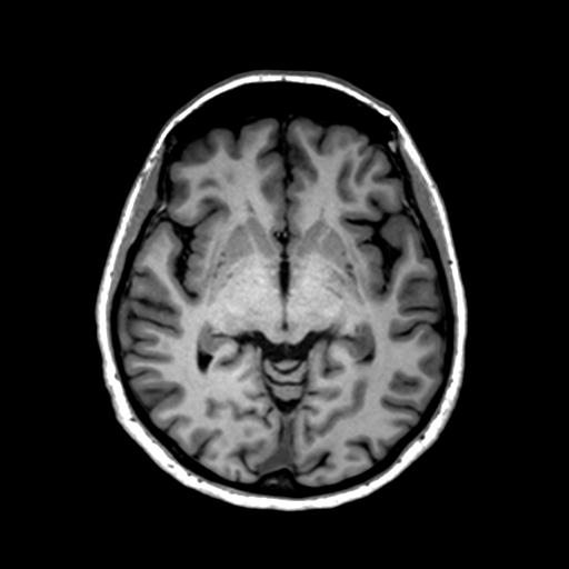 File:Autoimmune limbic encephalitis (Radiopaedia 30363-31005 T1 Axial 1mm 71).jpg
