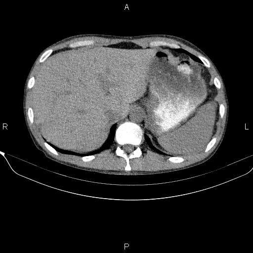 Autoimmune pancreatitis (Radiopaedia 84925-100431 Axial non-contrast 13).jpg