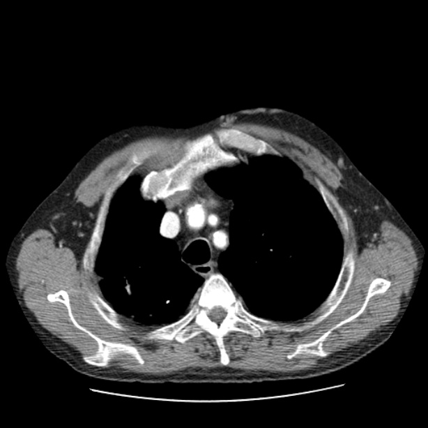 Autosomal dominant polycystic kidney disease (Radiopaedia 27851-28094 B 14).jpg