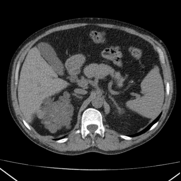 File:Autosomal dominant polycystic kidney disease (Radiopaedia 36539-38101 Axial non-contrast 25).jpg