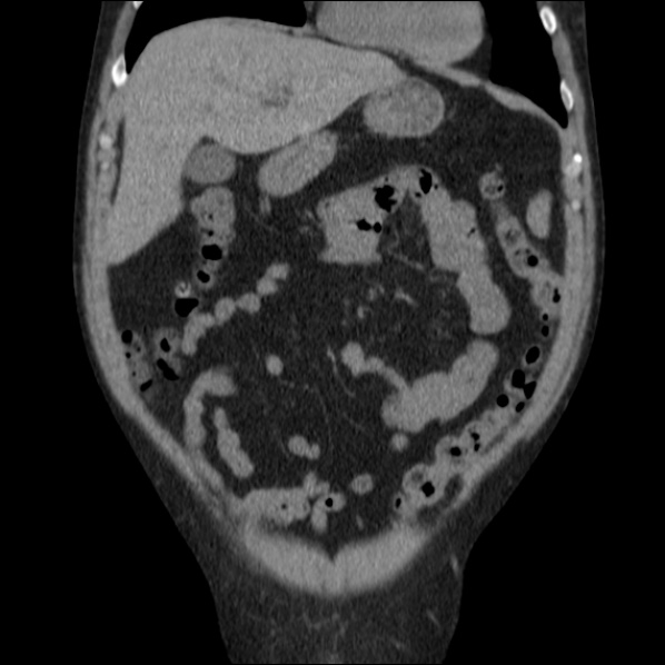 File:Autosomal dominant polycystic kidney disease (Radiopaedia 36539-38101 C 21).jpg