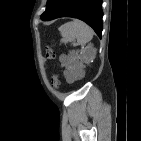 Autosomal dominant polycystic kidney disease (Radiopaedia 36539-38101 D 71).jpg