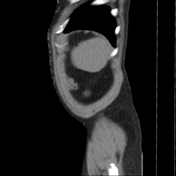Autosomal dominant polycystic kidney disease (Radiopaedia 36539-38101 D 77).jpg