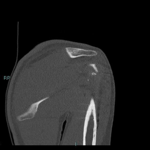 Avascular necrosis after fracture dislocations of the proximal humerus (Radiopaedia 88078-104655 Coronal bone window 56).jpg