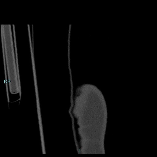 Avascular necrosis after fracture dislocations of the proximal humerus (Radiopaedia 88078-104655 Coronal bone window 6).jpg