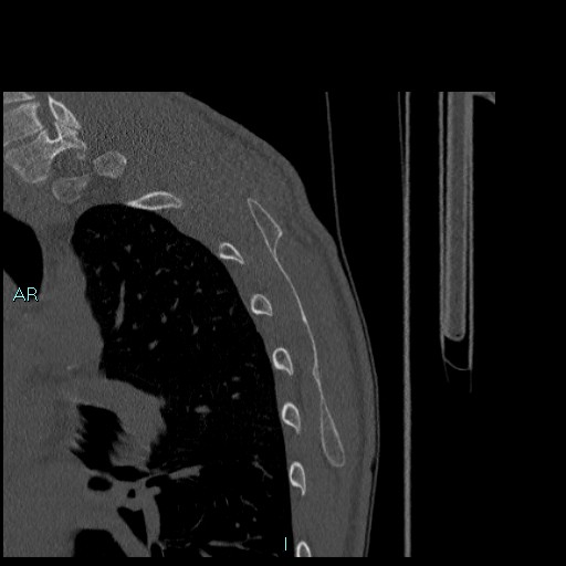 File:Avascular necrosis after fracture dislocations of the proximal humerus (Radiopaedia 88078-104655 Sagittal bone window 81).jpg