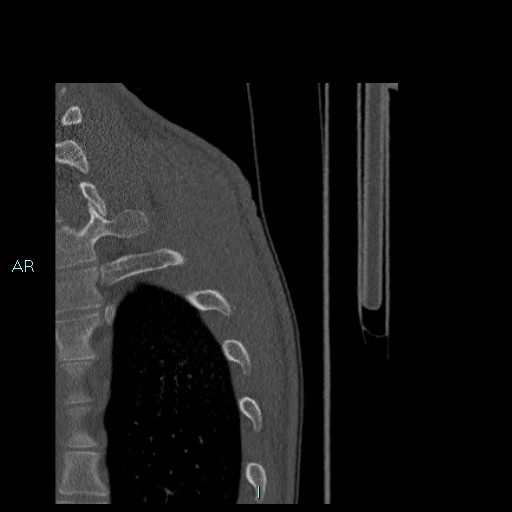 Avascular necrosis after fracture dislocations of the proximal humerus (Radiopaedia 88078-104655 Sagittal bone window 98).jpg