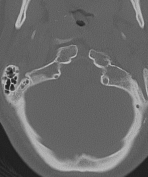 Axis peg fracture (type 3) and atlas lateral mass (type 4) fracture (Radiopaedia 37474-39324 Axial bone window 9).png
