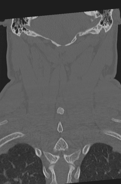 Axis peg fracture (type 3) and atlas lateral mass (type 4) fracture (Radiopaedia 37474-39324 Coronal bone window 45).png