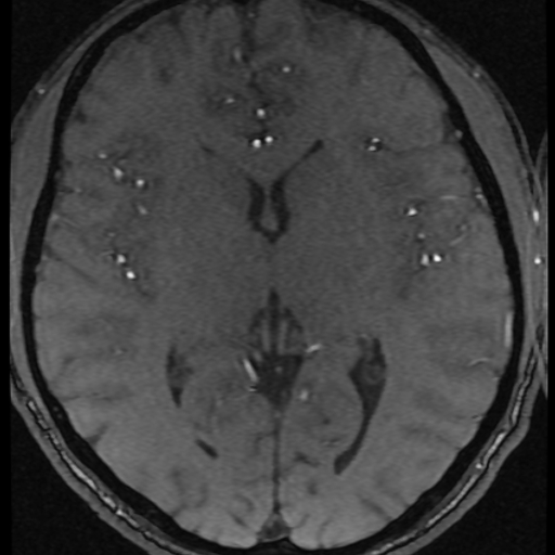 Azygos anterior cerebral artery (Radiopaedia 17059-16756 Axial MRA 11).jpg